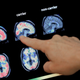 Ein Arzt zeigt auf PET-Scans des Gehirns von Menschen.